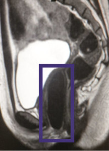 MRI image showing the lab-engineered vaginal organ