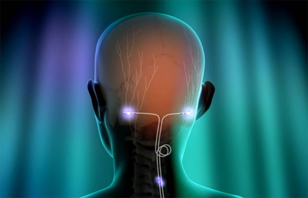 neuromodulation