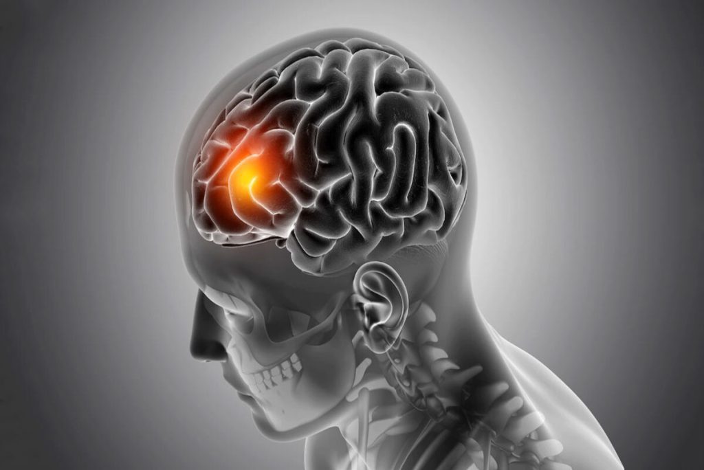 What Is The Most Common Cause Of Brain Injury