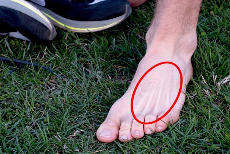 Will A Stress Fracture In Your Foot Heal On Its Own