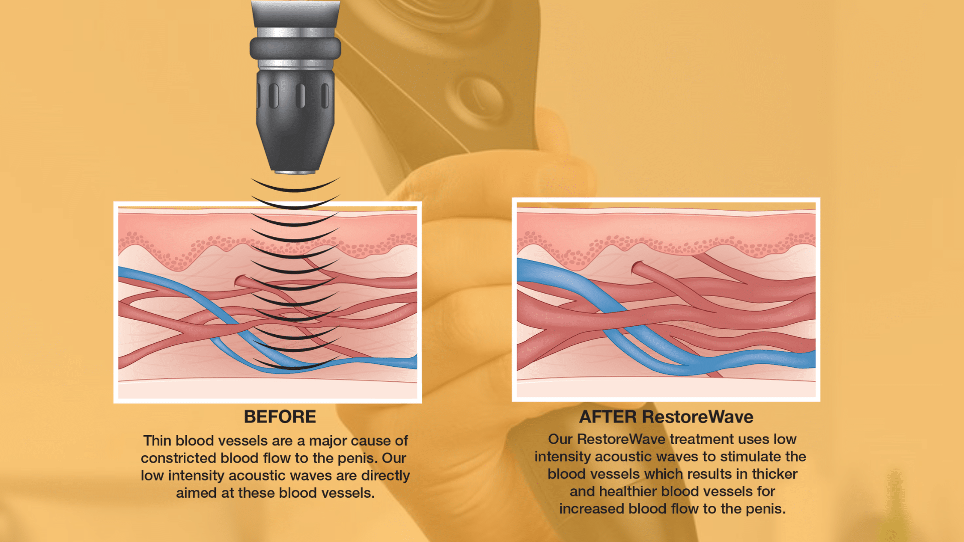 acoustic wave therapy for ed cost